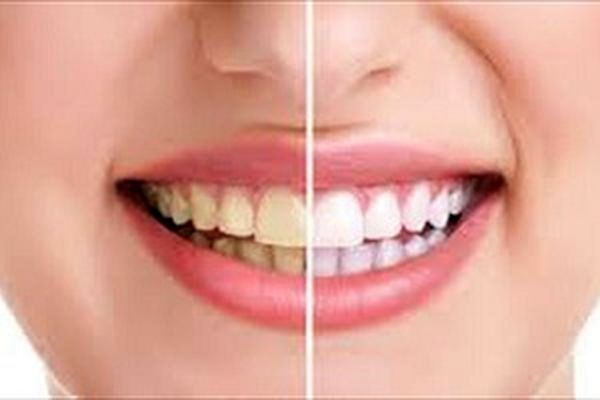 با نشانه های بیماری لثه آشنا شوید
