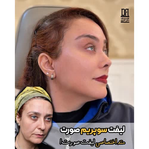 لیفت سوپریم صورت؛ متد اختصاصی هلدینگ دکتر اکبری
