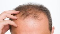 علت ریزش موی شدید چیست؟