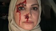 صورت زخمی و پُر از خون خانم بازیگر + عکس