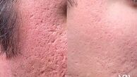 کلینیـک زیبایـی الیزه‌ لانژه؛ تاثیر سابسیژن بر رفع جای جوش