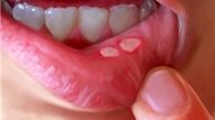 علت بروز آفت دهان چیست؟