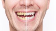 راه های جلوگیری از زردی دندان ها