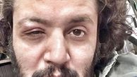چشم بازیگر مشهور زخمی شد + عکس