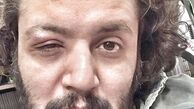 چشم بازیگر مشهور زخمی شد + عکس