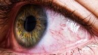 دلایل قرمزی و خارش پلک 