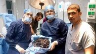 اشیاء عجیب در معدۀ زن مصری +تصاویر
