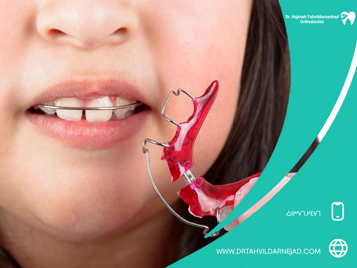 آیا ارتودنسی برگشت دارد؟ + راه های جلوگیری از برگشت ارتودنسی