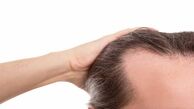 راهکارهای پرپشتی موی آقایان