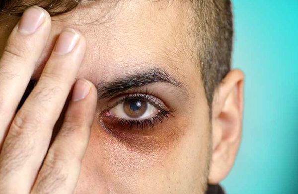 
چرا زیر چشم‌ ها تیره میشه؟
