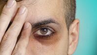 دلایل حلقه‌های تیره پای چشم