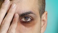 دلایل حلقه‌های تیره پای چشم