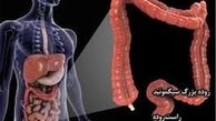 باکتری‌ دندان باعث سرطان می‌شود