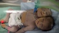 تولد نوزاد دو سر در غزه +تصاویر