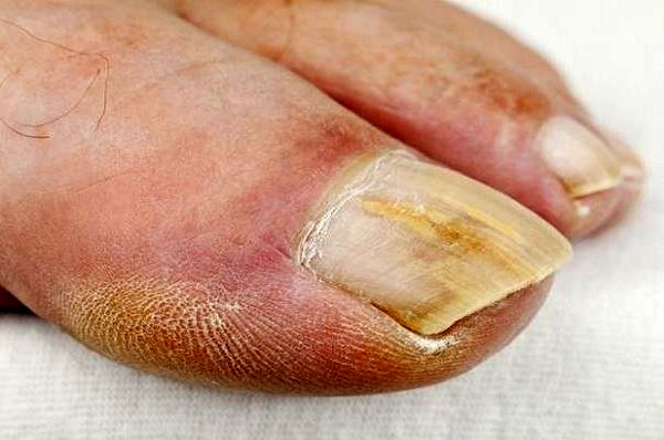 مشکلات ناخن در بهبودیافتگان کرونا !