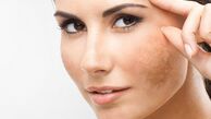 راهکار حذف لکه‌های قهوه‌ای ناشی از آفتاب روی پوست