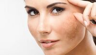 راهکار حذف لکه‌های قهوه‌ای ناشی از آفتاب روی پوست