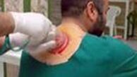 نکاتی که قبل از انجام حجامت باید بدانید