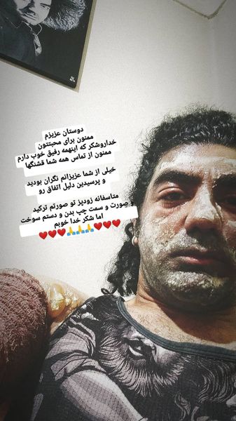 بازیگر جوان کشور دچار سانحه آتش سوزی شد + عکس