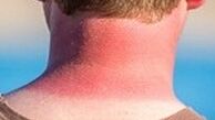 هزینه‌های میلیونی برای شکلاتی شدن پوست 