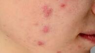 تاثیر مخرب استرس مزمن بر سلامت پوست