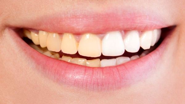 علت تغییر رنگ دندان ها چیست؟