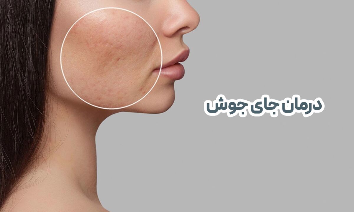 سریعترین روش از بین بردن جای جوش