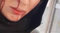 خانم بازیگر با سر شکسته و صورت خونین+عکس