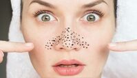 ریشه کن کردن جوش سر سیاه بینی با 10 ترفند خانگی