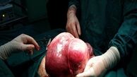 
خارج کردن توده 5 کیلویی از شکم بیمار + عکس
