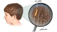 دلایل شیوع بیماری شپش در کودکان
