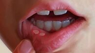 دلیل آفت دهان کمبود کدام ویتامین هاست؟