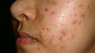 باورهای غلط درباره آکنه را فراموش کنید