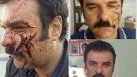 صورت ترکیده آقای بازیگر + عکس