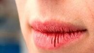 علت ترک خوردن لب‌ها چیست ؟