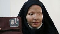 قربانی اسیدپاشی: حاضر بودم با اسلحه به سرم شلیک می‌کردند