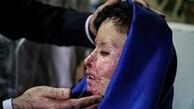 
قربانی اسیدپاشی به آمریکا رفت
