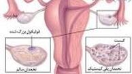 این ۲ عامل رایج تولید کیست در خانم ها که توجه نمی‌کنند