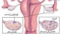 این ۲ عامل رایج تولید کیست در خانم ها که توجه نمی‌کنند