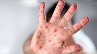 راه های انتقال آبله میمون و نحوه در امان ماندن از آن