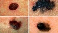 علایم سرطان پوست در 10 نقطه نامتعارف بدن
