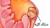 مهم ترین عوامل تشکیل سنگ کلیه 