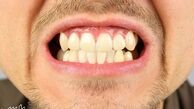 علت دندان قروچه در روز و شب چیست ؟ عوارض ؛ پیشگیری ؛ درمان