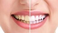 با نشانه های بیماری لثه آشنا شوید